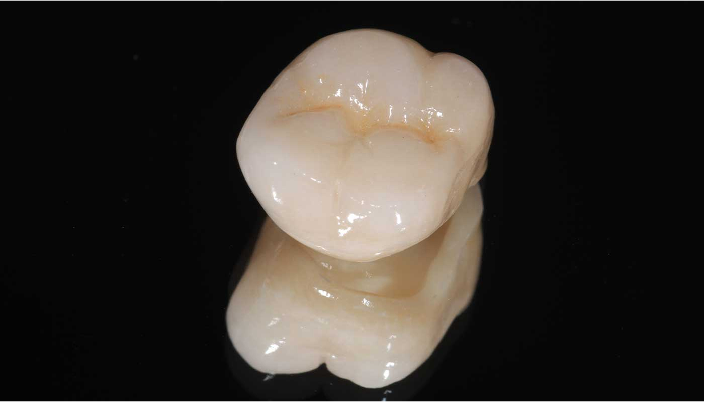 ジルコニアクラウン