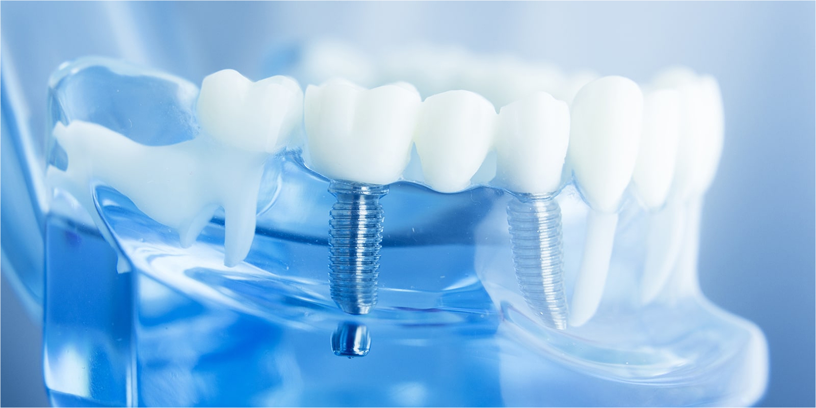 当院のインプラント治療の特徴