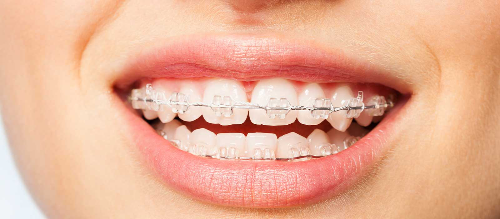 大人の矯正(ワイヤー矯正)について